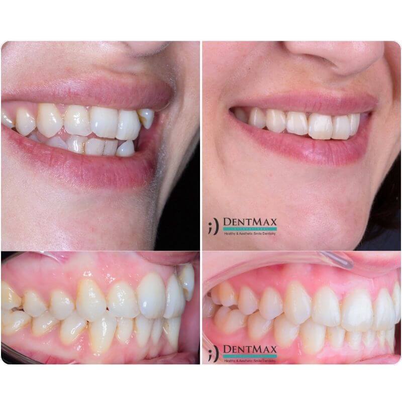 Dentmax