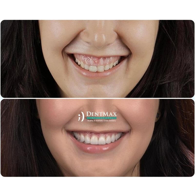 Dentmax