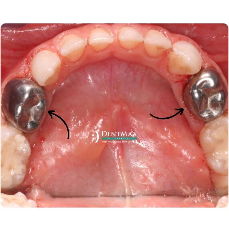 Dentmax