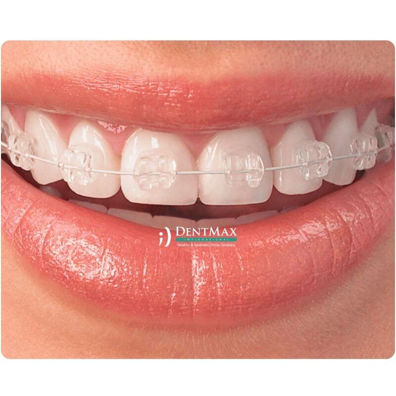 Dentmax