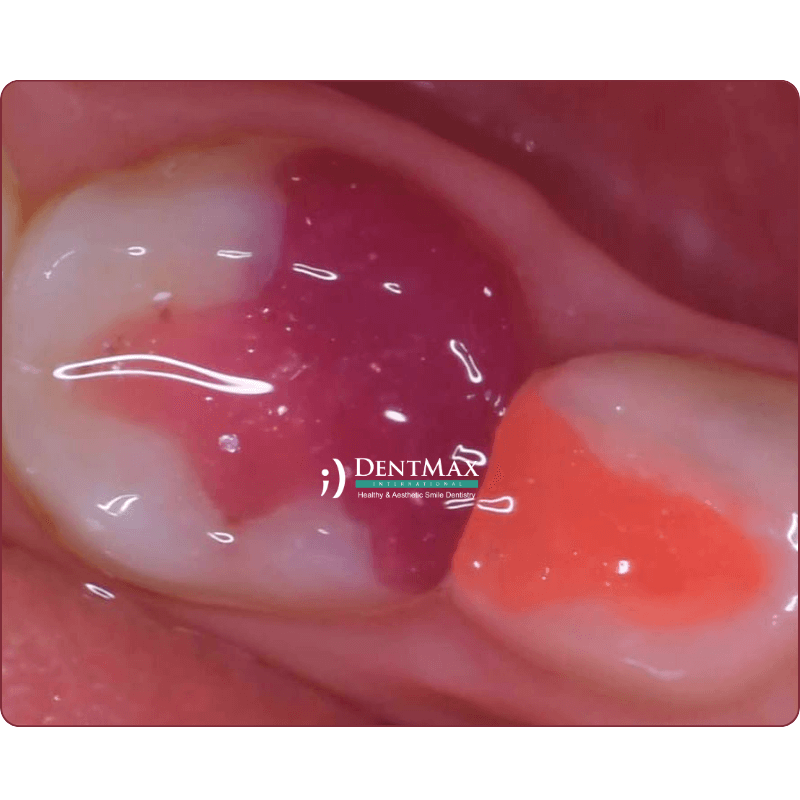 Dentmax