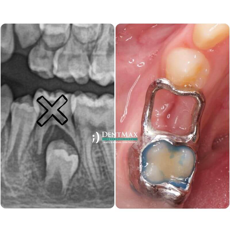 Dentmax
